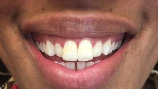 Teeth Bonding Procedure Teeth Bondng Before and After [upl. by Jepson]