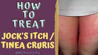 HOW TO TREAT JOCKS ITCH  TINEA CRURIS [upl. by Thurnau]