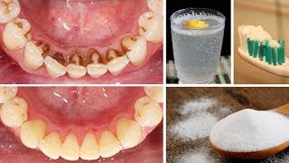 Dental Cleaning  CloseUp View ASMR [upl. by Assenov]