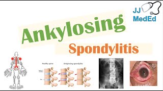 Ankylosing Spondylitis  HLAB27 Pathophysiology Signs amp Symptoms Diagnosis Treatment [upl. by Tsew61]