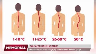 Skolyoz belirtileri nelerdir  Prof Dr Emre Acaroğlu Ortopedi ve Travmatoloji Uzmanı [upl. by Araeic237]