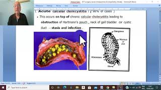 CHOLECYSTITIS Causes Signs and Symptoms Diagnosis and Treatment [upl. by Ruffin]