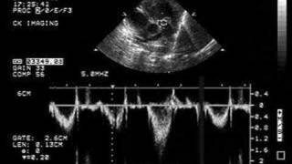 Pulmonary Stenosis [upl. by Hilda]