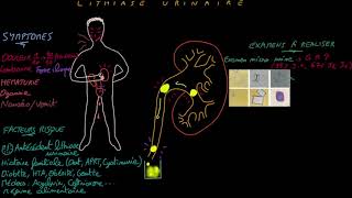 Extracorporeal Shock Wave Lithotripsy ESWL – CIMS Hospital [upl. by Snapp966]