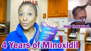 UPDATE  Minoxidil  4 YEARS LATER  TV Blake Review [upl. by Htebharas]