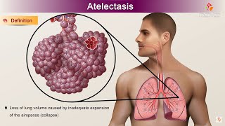 Atelectasis  Etiology Clinical Features Pathology pathophysiology Diagnosis and Treatment [upl. by Novel]