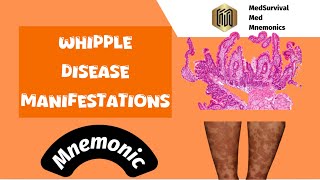 Whipple Disease Presentations The Easy Mnemonic [upl. by Judas]