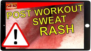 How To Treat Sweat Rash [upl. by Richer334]