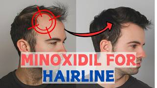 Minoxidil for Frontal Baldness  Restore Your Hairline [upl. by Phi]