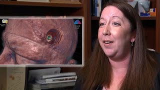 Woman relieved after brain tumor turns out to be parasite [upl. by Nolahc]