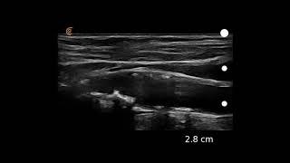 Image Interpretation Carotid Atherosclerosis [upl. by Altman]