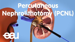 Technique amp Outcomes Partial Nephrectomy [upl. by Ob]