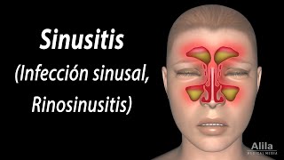 Sinusitis Animación Alila Medical Media Español [upl. by Laira56]