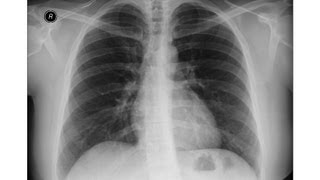 chest xray  Idiopathic Pulmonary Fibrosis [upl. by Novy]