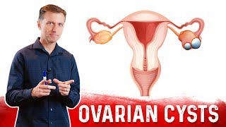 Ovarian Cysts Causes Symptoms amp Natural Treatment – DrBerg [upl. by Ysak624]