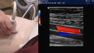 How To Lower Extremity Arterial Duplex Exam [upl. by Bolling850]