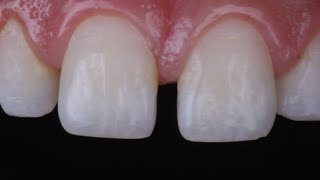 diastema closure with composite resin [upl. by Reld]