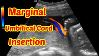 Marginal Umbilical Cord Insertion [upl. by Eedoj767]