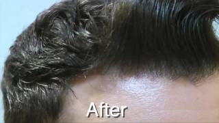 Norwood 3  3300 Graft FUT Hair Transplant  SHI Toronto  4147477873 [upl. by Anigroeg740]