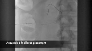 Percutaneous Nephrostomy [upl. by Ahsiemal931]