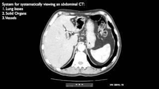 How to interpret an abdominal CT [upl. by Kina317]