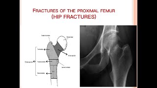 Fracture of Proximal Femur [upl. by Ycniuqed414]