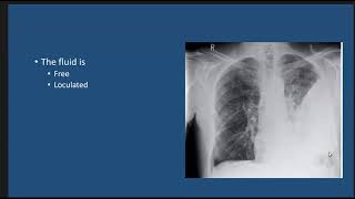 Thoracic Empyema case discussion [upl. by Fidellia]