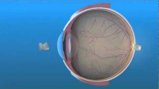 Intraocular Lens IOL [upl. by Naanac973]