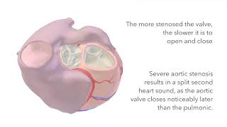 Aortic Stenosis  Murmur Sound amp Animation [upl. by Holli]