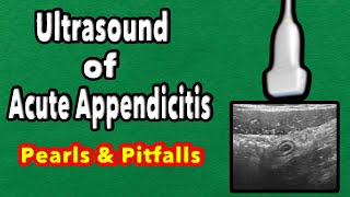 Ultrasound Cases of Acute Appendicitis Cine Clips [upl. by Nay]