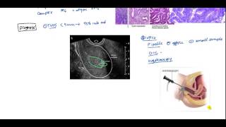 Endometrial Cancer and Hyperplasia for USMLE [upl. by Rifkin]