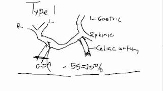 Helicobacter pylori gastritis Pathogenesis and morphology [upl. by Voletta]