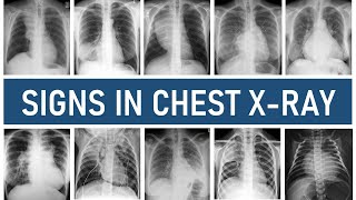 Signs in Chest Xray [upl. by Ahsaela]