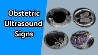 Obstetric Ultrasound Signs [upl. by Cleon]