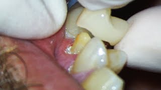 Dental Crown EXPLAINED and how much Tooth Youll Lose [upl. by Znarf]