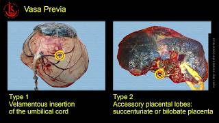 Vasa Previa Ultrasound Diagnosis [upl. by Berti891]