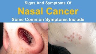 Signs And Symptoms Of Nasal Cancer [upl. by Fante98]