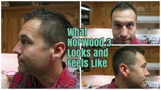 What Norwood 3 Looks and Feels Like Receding HairlineBalding [upl. by Dahlstrom]