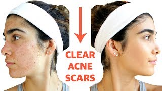 CLEAR ACNE SCARS FAST  DIY Face Masks That WORK [upl. by Wollis]