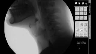 Honey Thick Liquids  Modified Barium Swallow Study MBSS Lateral View HD [upl. by Nonnaer]