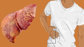 3 Natural Home Remedies For TREATING CIRRHOSIS OF THE LIVER [upl. by Madaras]