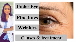 Fine lines  wrinkles under eye causes amp treatment Prevention  Dr Aanchal Panth [upl. by Analed]