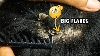 Dandruff Scratching Big Flakes Dandruff Removal Satisfying 289 [upl. by Seline583]