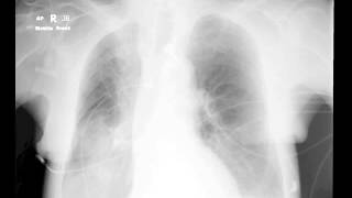 Pulmonary infiltrates in ICU [upl. by Tica]