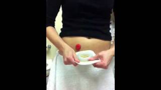 Ostomy pouch change using ConvaTec moldable [upl. by Oberstone]