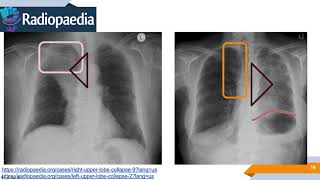 Imagenología de Tórax Signos Radiológicos [upl. by Nafets943]