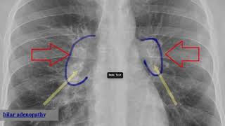 bilateral hilar adenopathy [upl. by Notserk]