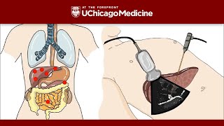 Understanding Spinal Tumors From Diagnosis to Treatment [upl. by Nebuer715]