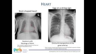 Approach to Pediatric Chest XRays [upl. by Lednam]