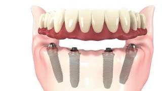 Allon4 Dental Implants Simple Procedure Animation [upl. by Groveman]